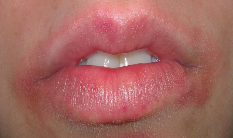 triệu chứng dị ứng son môi