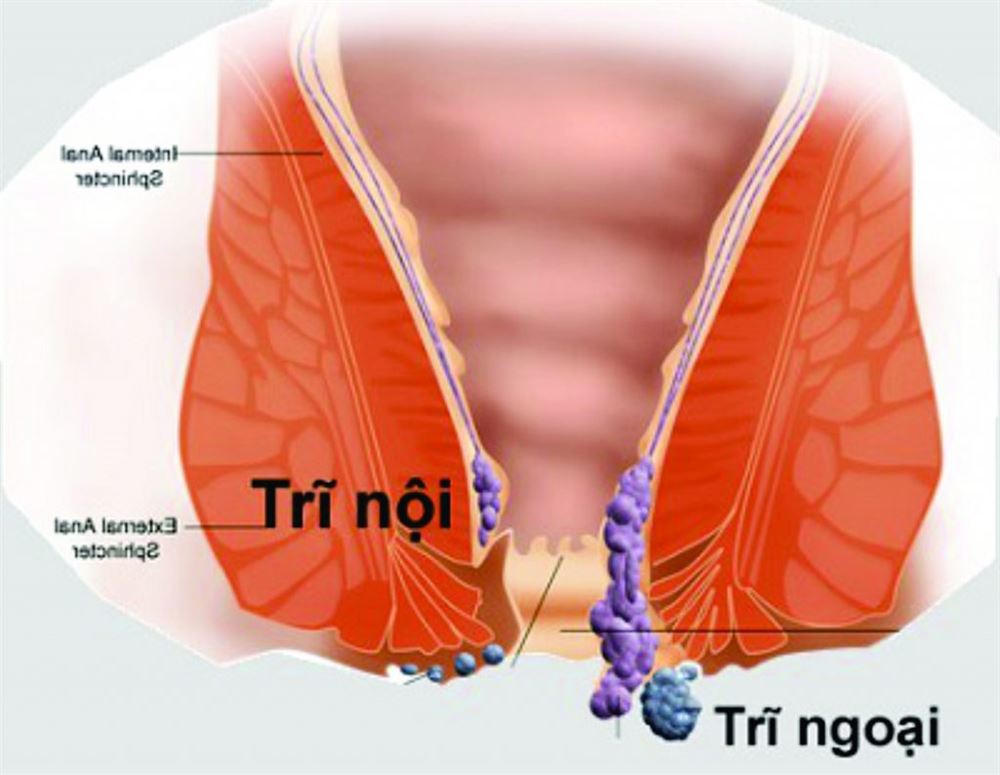 các loại bệnh trĩ