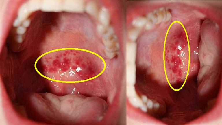 Thông tin về bệnh viêm họng hạt và cách điều trị