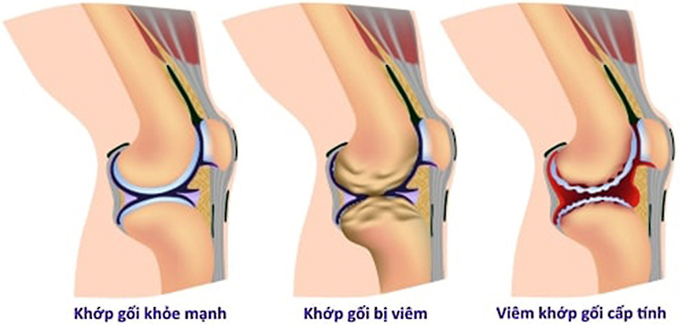 Các thông tin cần biết về bệnh viêm khớp gối