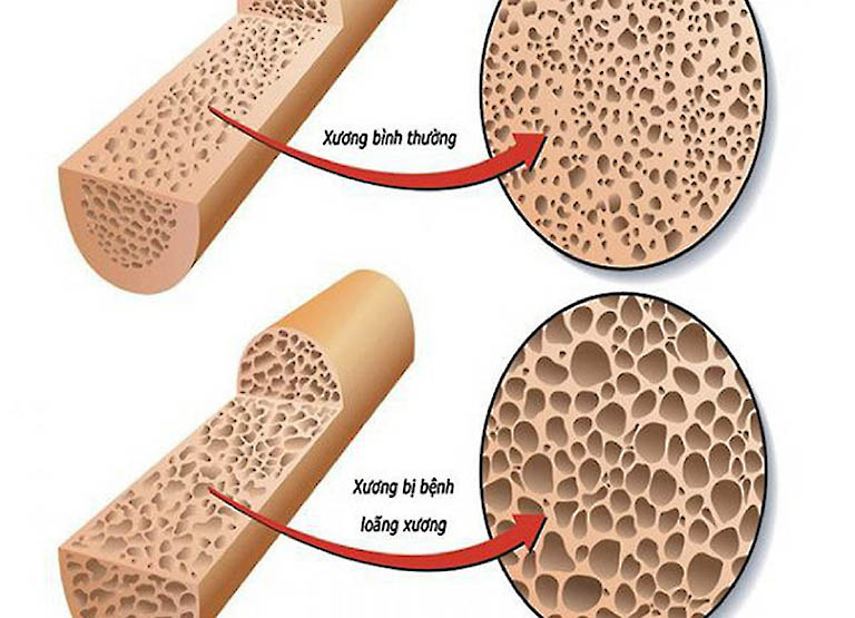 Thiếu canxi ở người lớn có biểu hiện gì? Cách khắc phục ra sao?