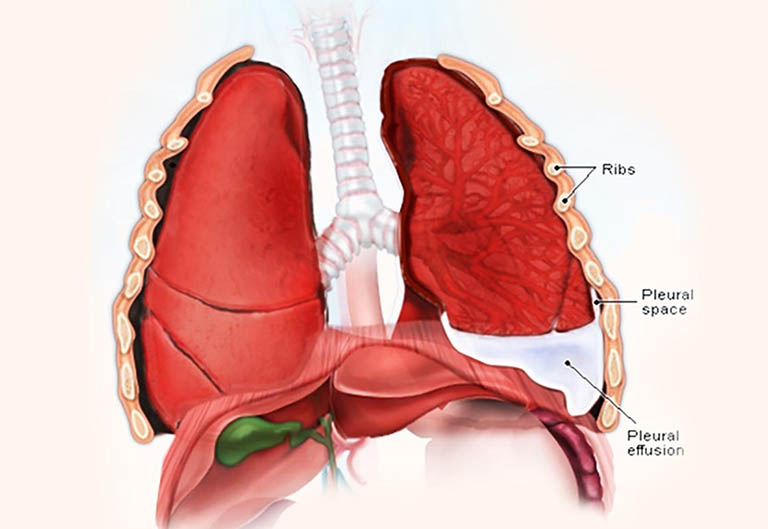 Tràn dịch phổi