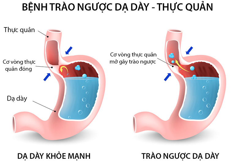 Trào ngược dạ dày thực quản