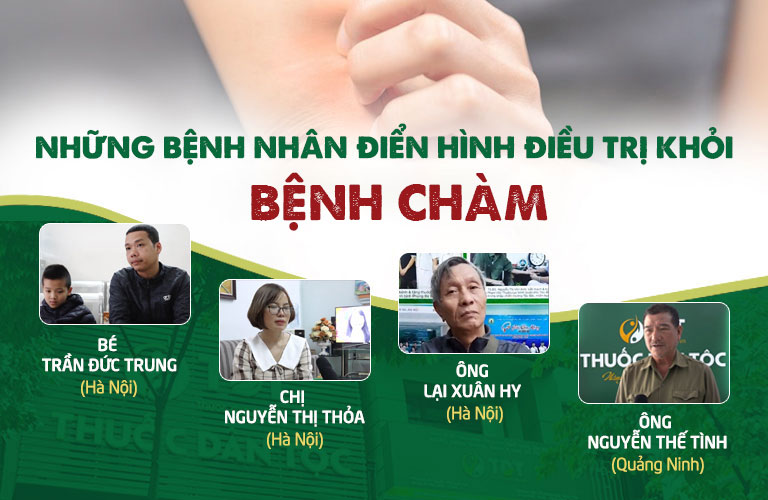 Những bệnh nhân đã điều trị khỏi bệnh chàm bằng Thanh bì dưỡng can thang