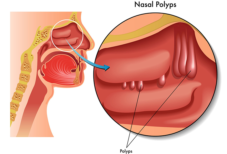 Phẫu thuật cắt polyp mũi có đau không? Hết bao nhiêu tiền?