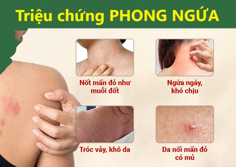 Triệu chứng bệnh phong ngứa