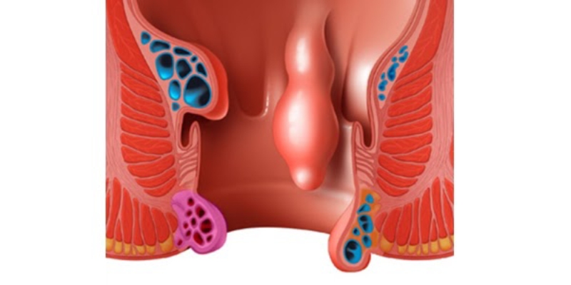 Bệnh trĩ hình ảnh tắc mạch