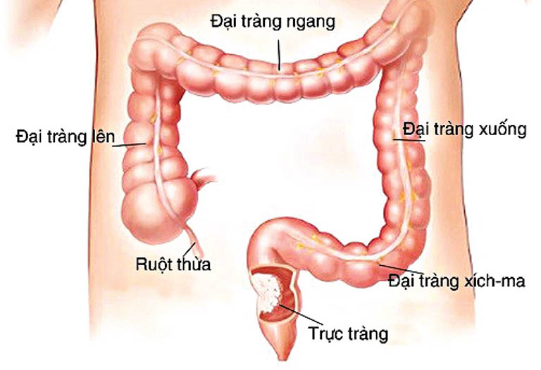 U trực tràng là gì, có nguy hiểm không? Cách điều trị