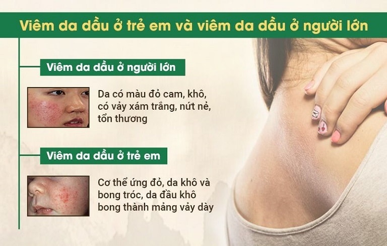 Viêm da tiết bã xảy ra ở mọi lứa tuổi