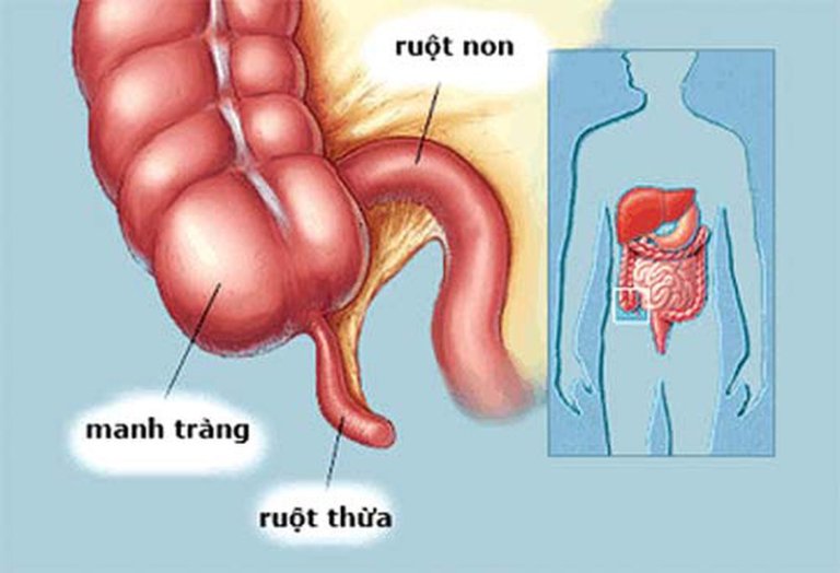 Bệnh viêm manh tràng